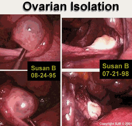 ovarian Isolation caused by tubal ligation