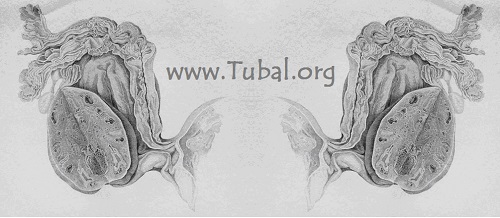 www.Tubal.org