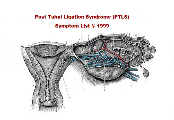 Post Tubal Ligation Syndrome PTLS Symptom List c 1999